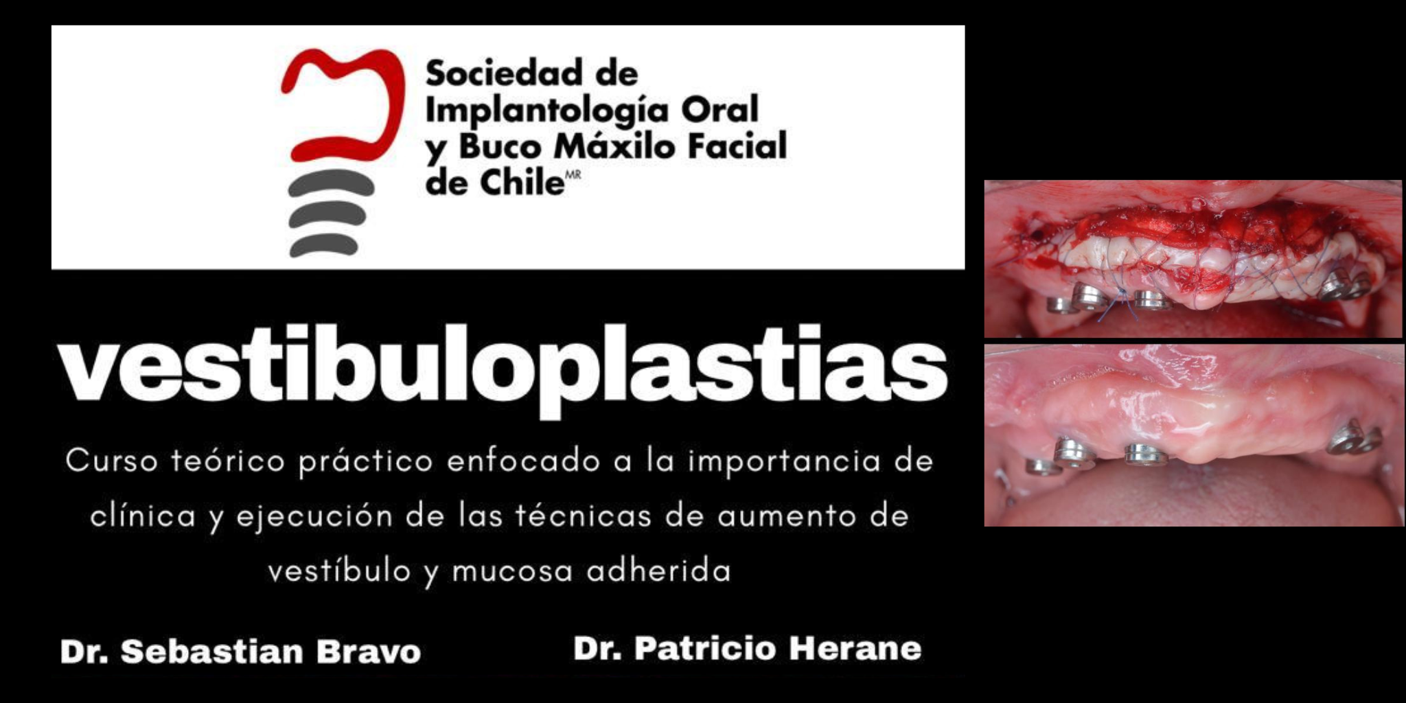 vestibuloplastias-SIOCH-(6)